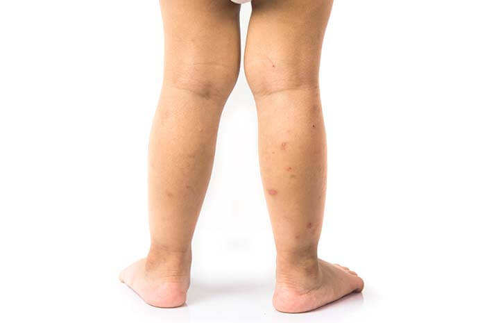 polio